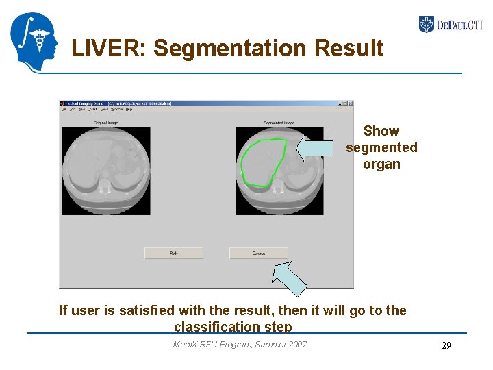 LIVER: Segmentation Result Show segmented organ If user is satisfied with the result, then