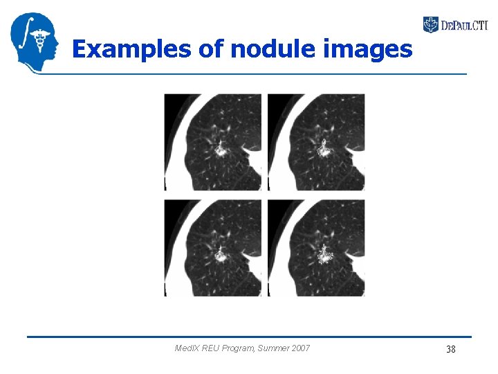 Examples of nodule images Med. IX REU Program, Summer 2007 38 