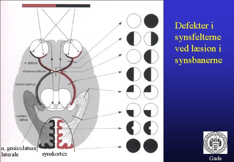 Defekter i synsfelterne ved læsion i synsbanerne Gade 