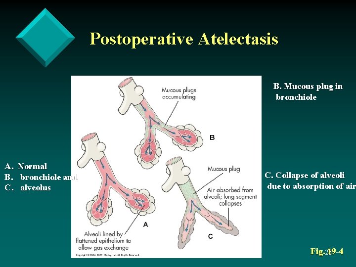 Postoperative Atelectasis B. Mucous plug in bronchiole A. B. C. Normal bronchiole and alveolus