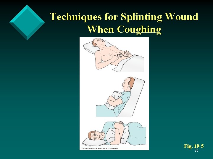 Techniques for Splinting Wound When Coughing Fig. 19 -5 26 