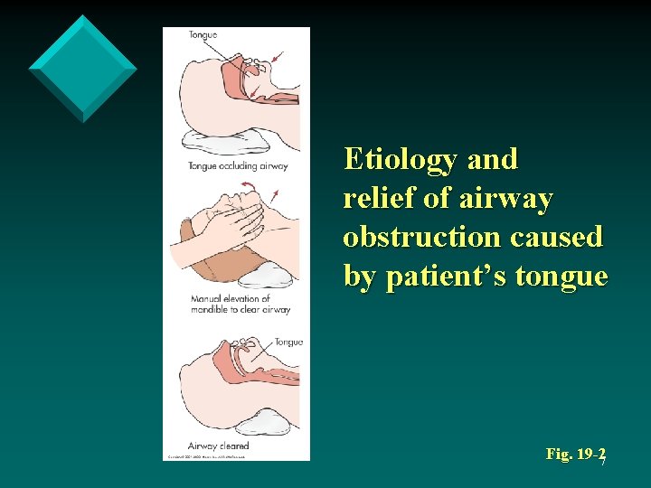 Etiology and relief of airway obstruction caused by patient’s tongue Fig. 19 -27 