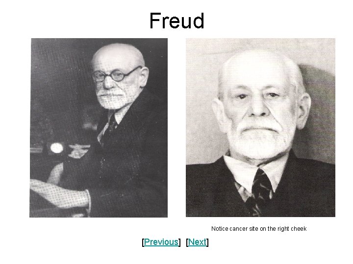Freud Notice cancer site on the right cheek [Previous] [Next] 