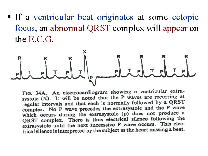 § If a ventricular beat originates at some ectopic focus, an abnormal QRST complex