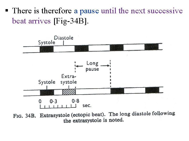 § There is therefore a pause until the next successive beat arrives [Fig 34