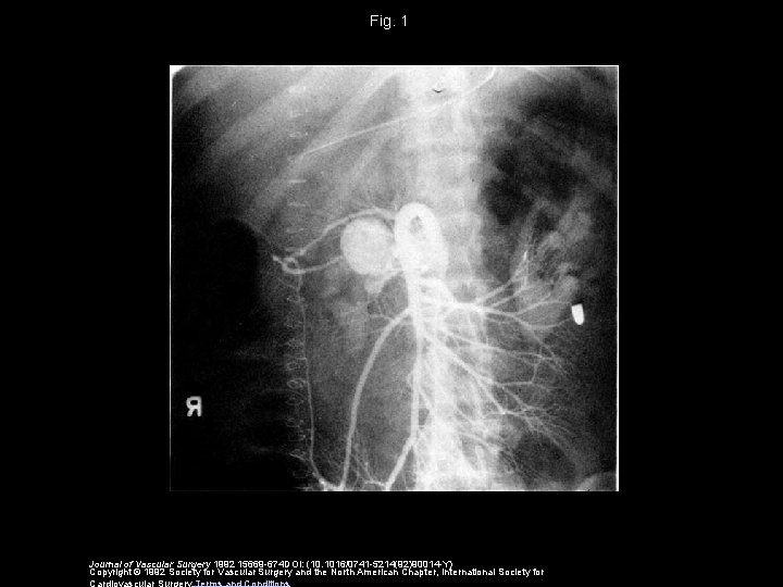 Fig. 1 Journal of Vascular Surgery 1992 15669 -674 DOI: (10. 1016/0741 -5214(92)90014 -Y)