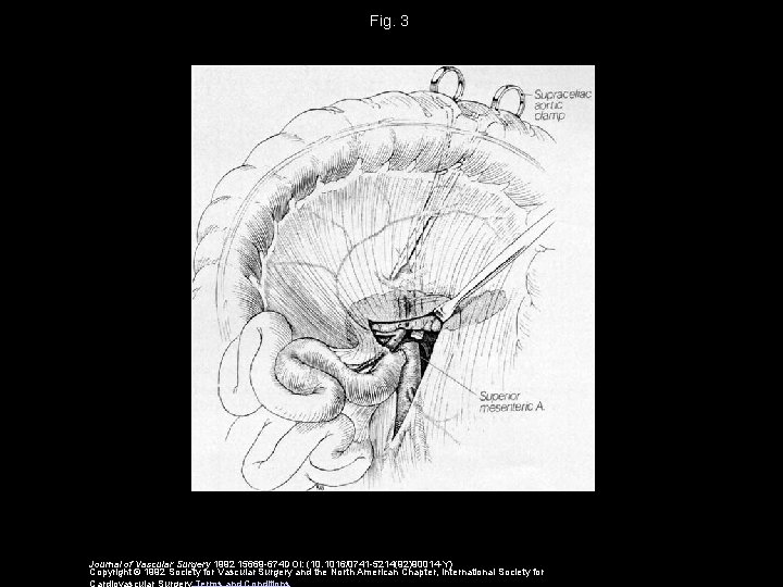 Fig. 3 Journal of Vascular Surgery 1992 15669 -674 DOI: (10. 1016/0741 -5214(92)90014 -Y)