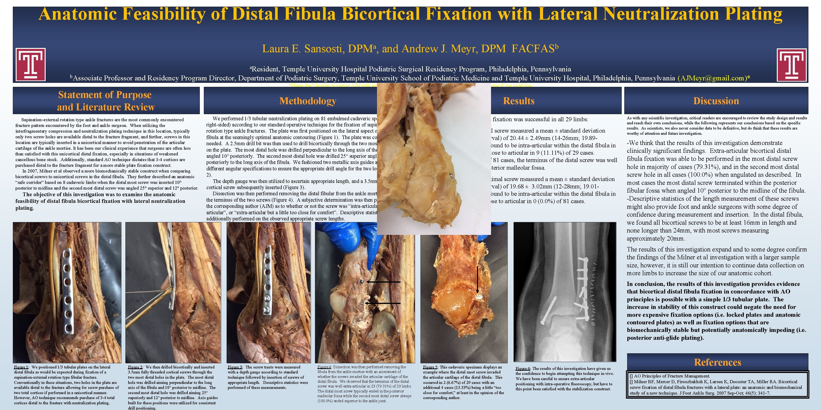 Anatomic Feasibility of Distal Fibula Bicortical Fixation with Lateral Neutralization Plating Laura E. Sansosti,