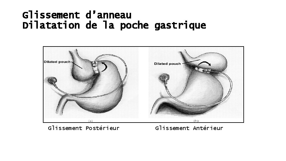 Glissement d’anneau Dilatation de la poche gastrique Glissement Postérieur Glissement Antérieur 