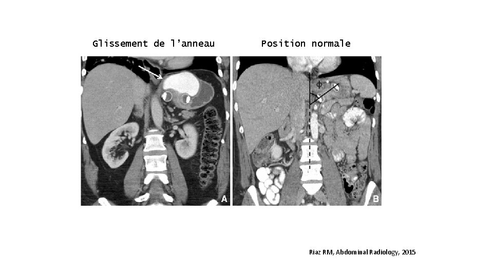 Glissement de l’anneau Position normale Riaz RM, Abdominal Radiology, 2015 