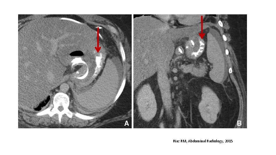 Riaz RM, Abdominal Radiology, 2015 