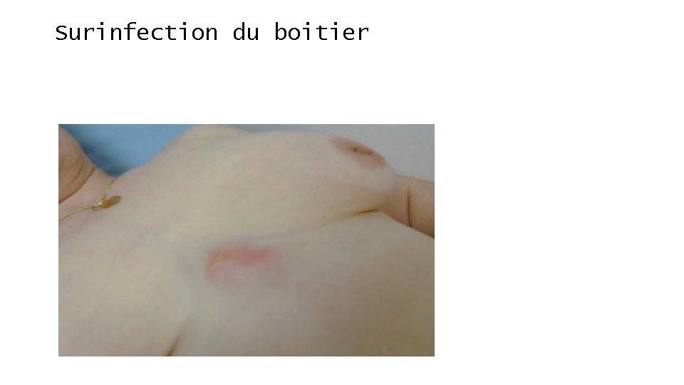 Surinfection du boitier 