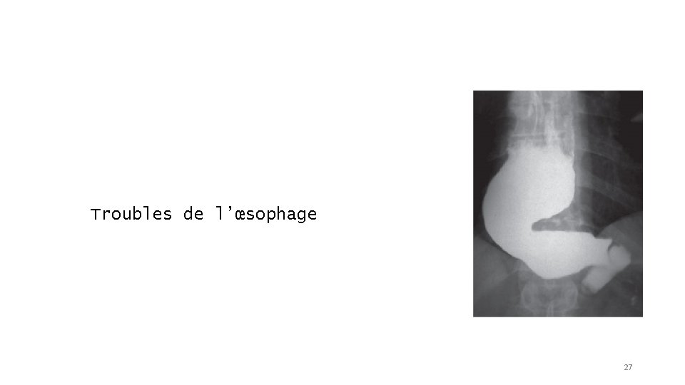 Troubles de l’œsophage 27 