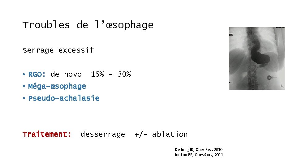 Troubles de l’œsophage Serrage excessif • RGO: de novo 15% - 30% • Méga-œsophage