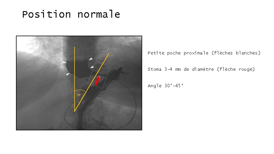 Position normale Petite poche proximale (flèches blanches) Stoma 3 -4 mm de diamètre (flèche