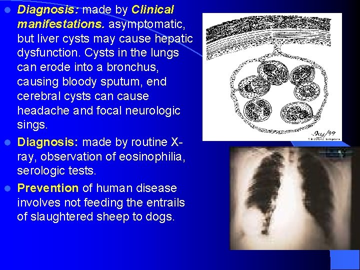 Diagnosis: made by Clinical manifestations. asymptomatic, but liver cysts may cause hepatic dysfunction. Cysts