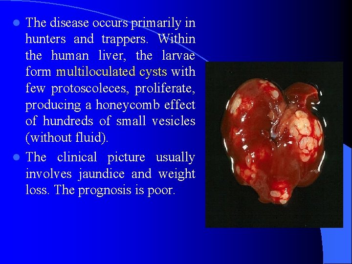 The disease occurs primarily in hunters and trappers. Within the human liver, the larvae