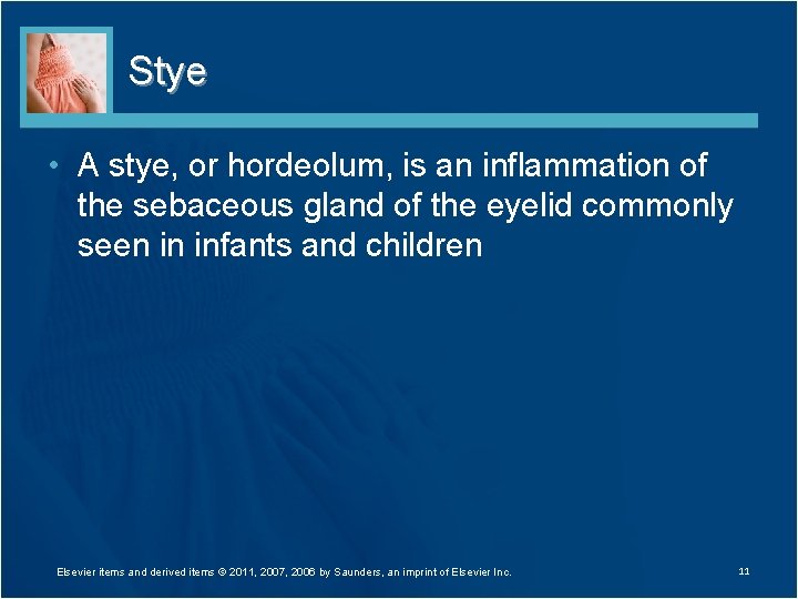 Stye • A stye, or hordeolum, is an inflammation of the sebaceous gland of