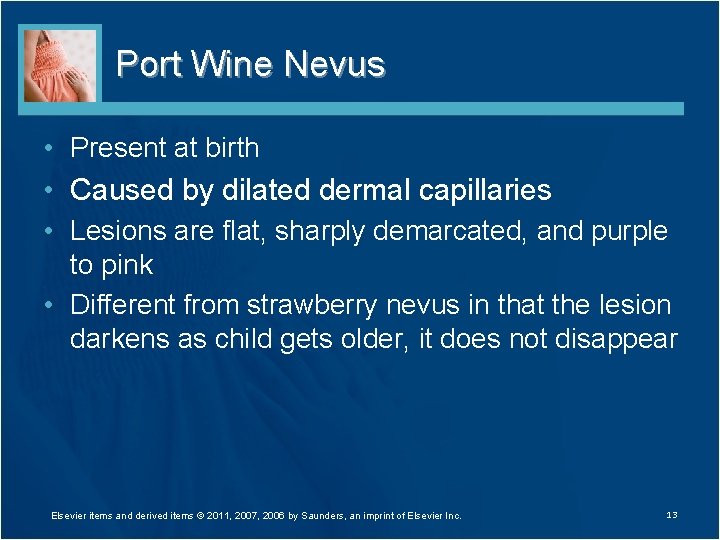 Port Wine Nevus • Present at birth • Caused by dilated dermal capillaries •