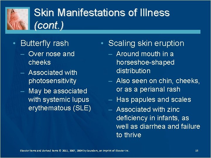 Skin Manifestations of Illness (cont. ) • Butterfly rash – Over nose and cheeks