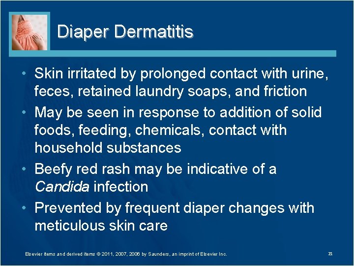 Diaper Dermatitis • Skin irritated by prolonged contact with urine, feces, retained laundry soaps,