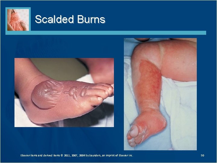 Scalded Burns Elsevier items and derived items © 2011, 2007, 2006 by Saunders, an