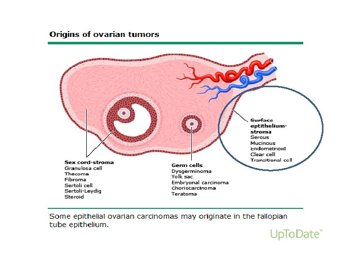 ovarian cancer uptodate