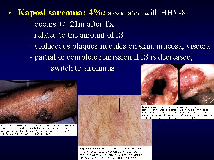  • Kaposi sarcoma: 4%: associated with HHV-8 - occurs +/- 21 m after