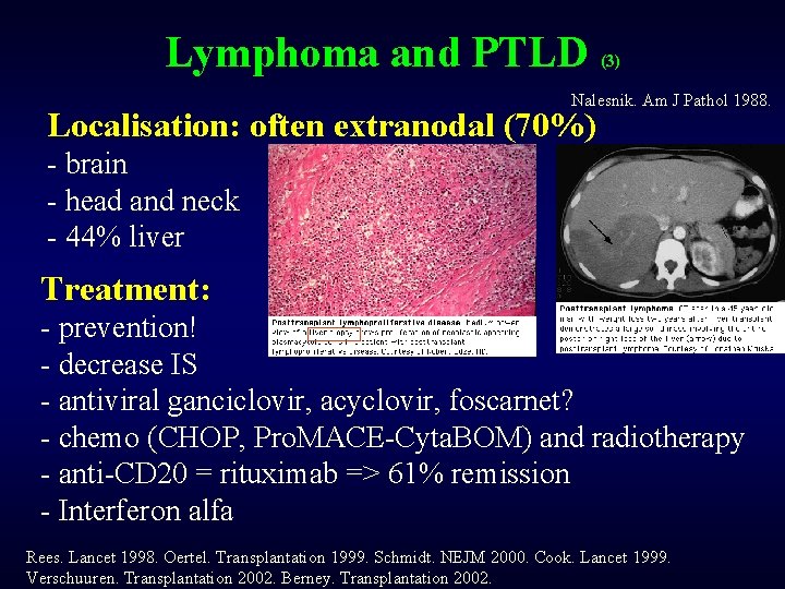 Lymphoma and PTLD (3) Nalesnik. Am J Pathol 1988. Localisation: often extranodal (70%) -