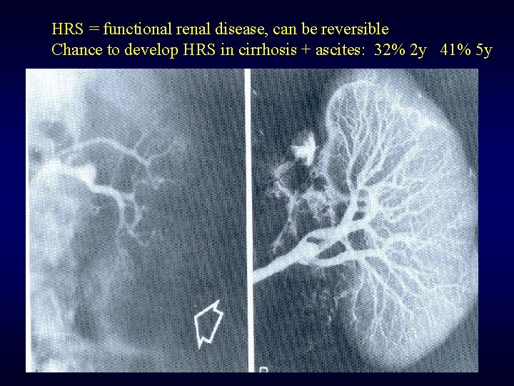 HRS = functional renal disease, can be reversible Chance to develop HRS in cirrhosis