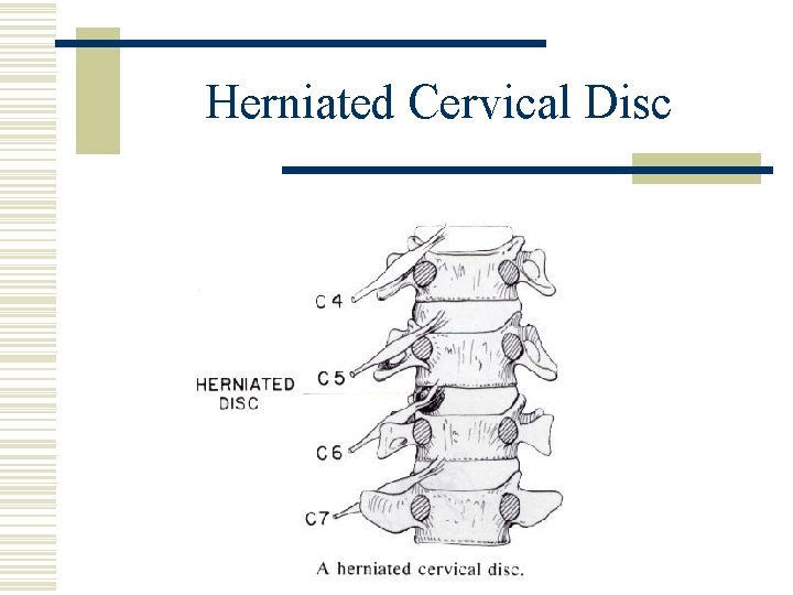 Herniated Cervical Disc 