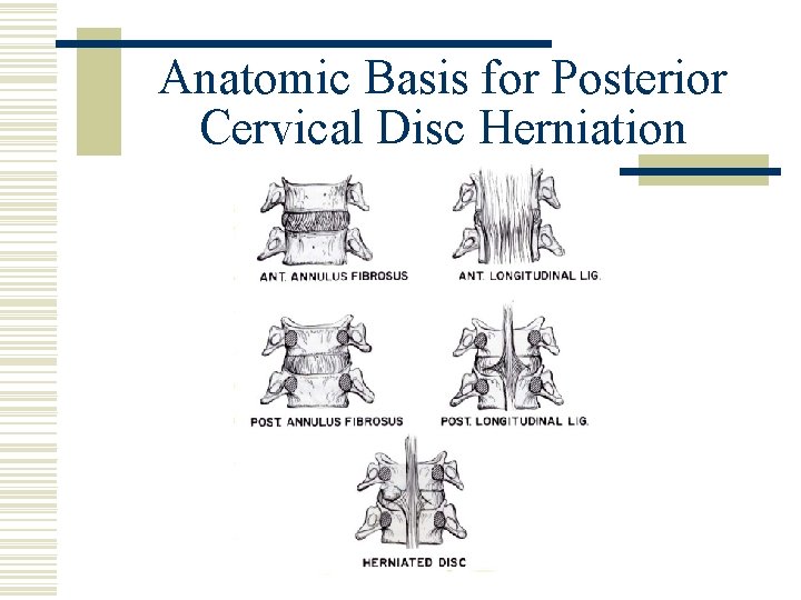 Anatomic Basis for Posterior Cervical Disc Herniation 