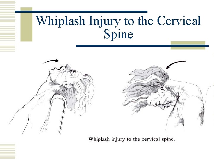 Whiplash Injury to the Cervical Spine 