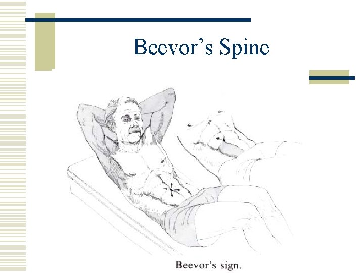 Beevor’s Spine 