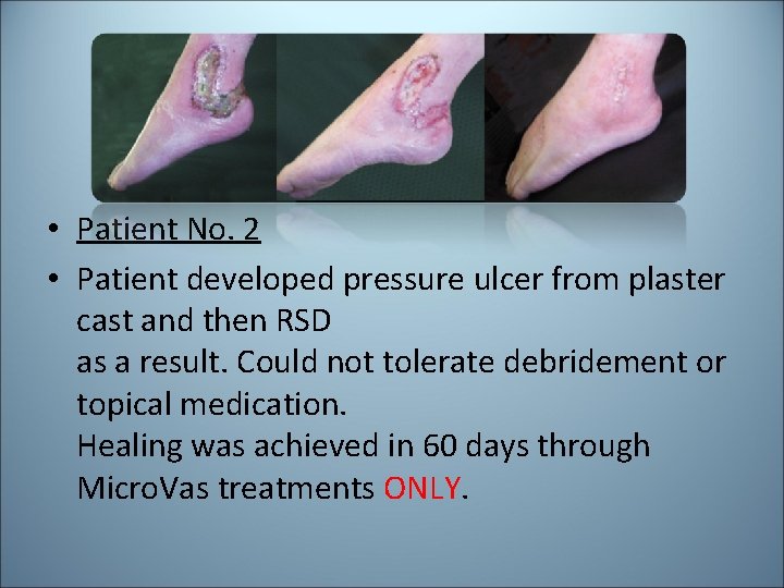 • Patient No. 2 • Patient developed pressure ulcer from plaster cast and • Patient No. 2 • Patient developed pressure ulcer from plaster cast and