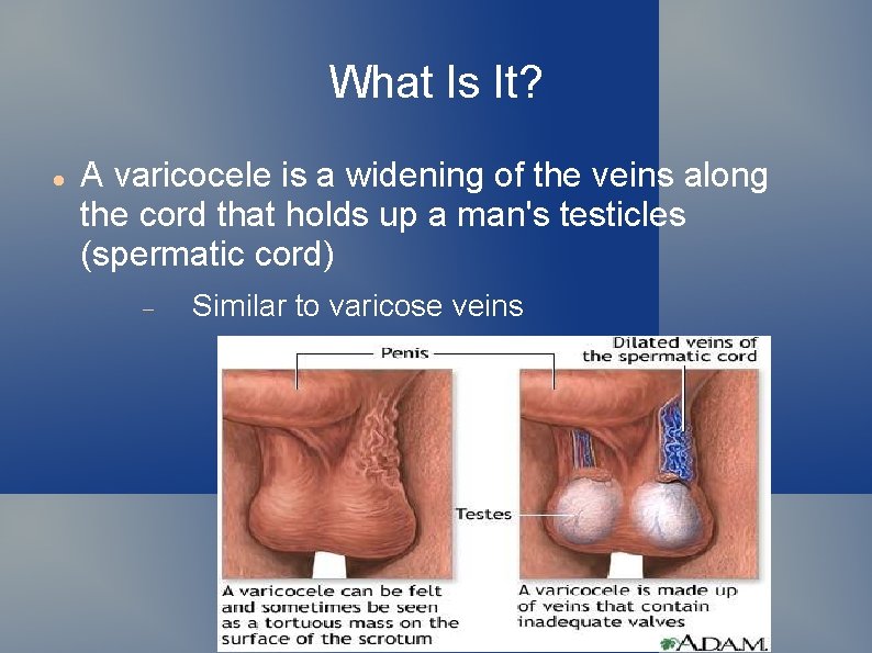 What Is It? A varicocele is a widening of the veins along the cord