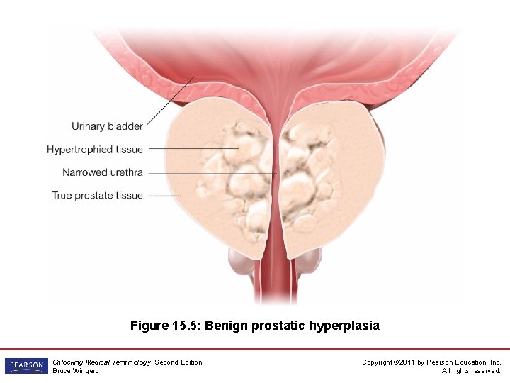 Figure 15. 5: Benign prostatic hyperplasia Unlocking Medical Terminology, Second Edition Bruce Wingerd Copyright