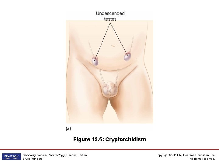 Figure 15. 6: Cryptorchidism Unlocking Medical Terminology, Second Edition Bruce Wingerd Copyright © 2011