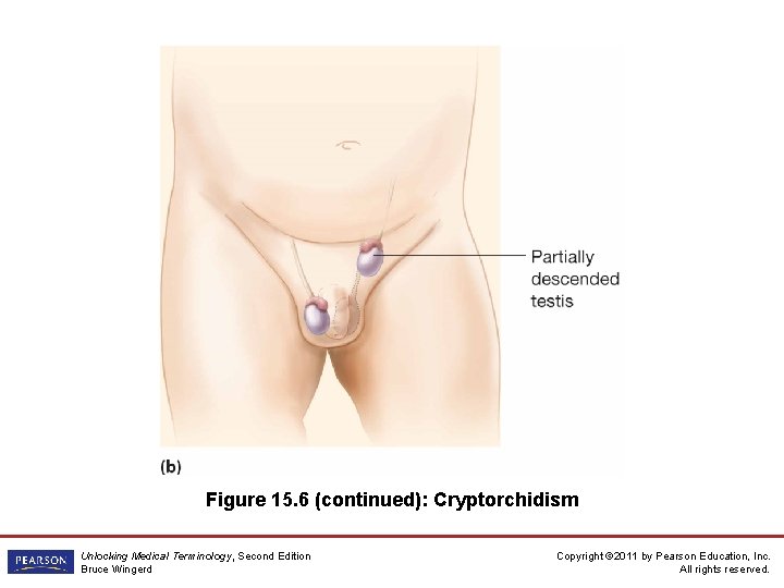 Figure 15. 6 (continued): Cryptorchidism Unlocking Medical Terminology, Second Edition Bruce Wingerd Copyright ©