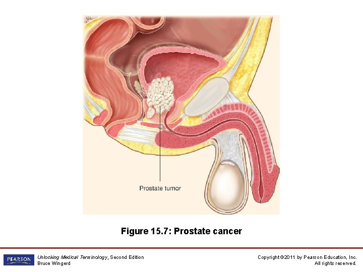 Figure 15. 7: Prostate cancer Unlocking Medical Terminology, Second Edition Bruce Wingerd Copyright ©
