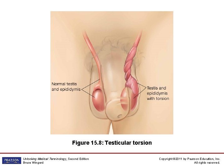 Figure 15. 8: Testicular torsion Unlocking Medical Terminology, Second Edition Bruce Wingerd Copyright ©