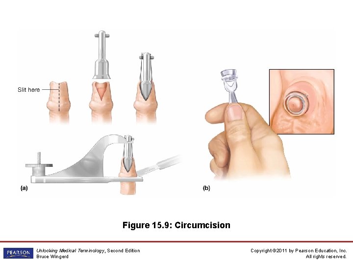Figure 15. 9: Circumcision Unlocking Medical Terminology, Second Edition Bruce Wingerd Copyright © 2011