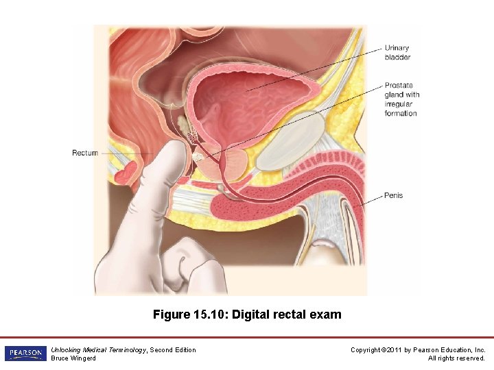 Figure 15. 10: Digital rectal exam Unlocking Medical Terminology, Second Edition Bruce Wingerd Copyright