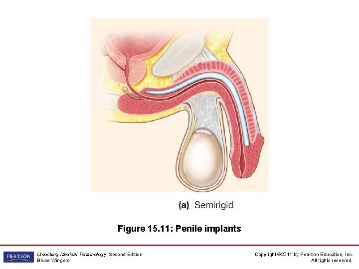 Figure 15. 11: Penile implants Unlocking Medical Terminology, Second Edition Bruce Wingerd Copyright ©