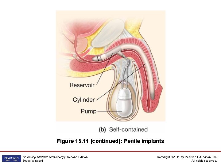 Figure 15. 11 (continued): Penile implants Unlocking Medical Terminology, Second Edition Bruce Wingerd Copyright