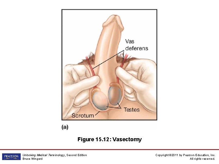 Figure 15. 12: Vasectomy Unlocking Medical Terminology, Second Edition Bruce Wingerd Copyright © 2011