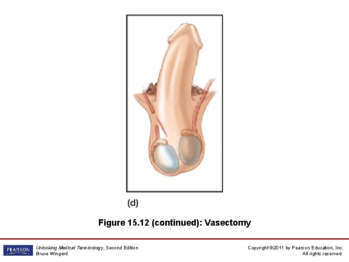 Figure 15. 12 (continued): Vasectomy Unlocking Medical Terminology, Second Edition Bruce Wingerd Copyright ©