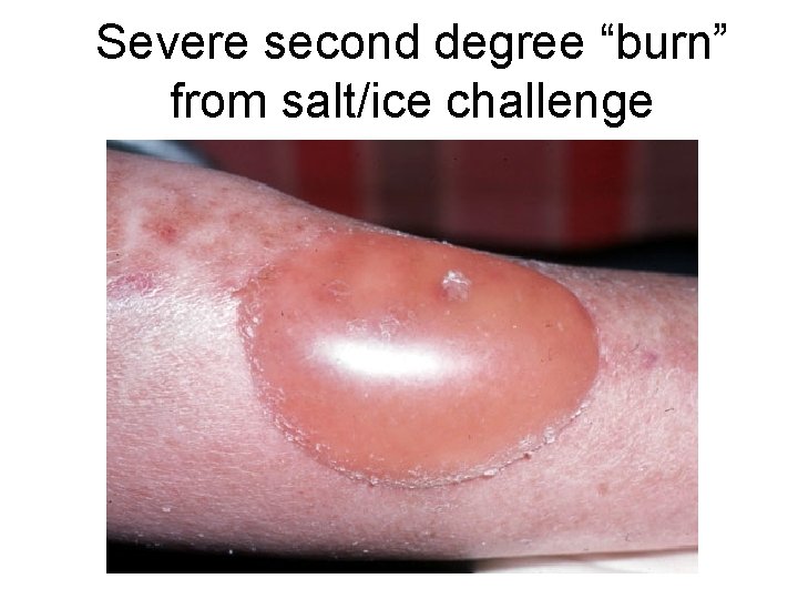 Severe second degree “burn” from salt/ice challenge Severe second degree “burn” from salt/ice challenge