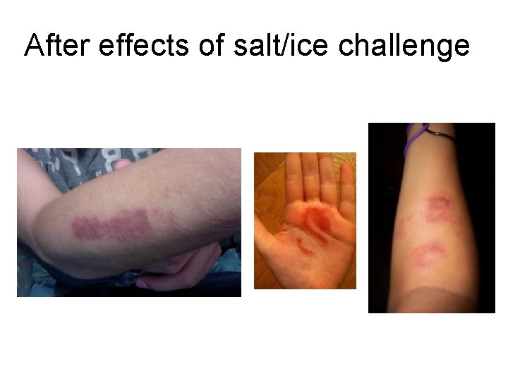 After effects of salt/ice challenge After effects of salt/ice challenge