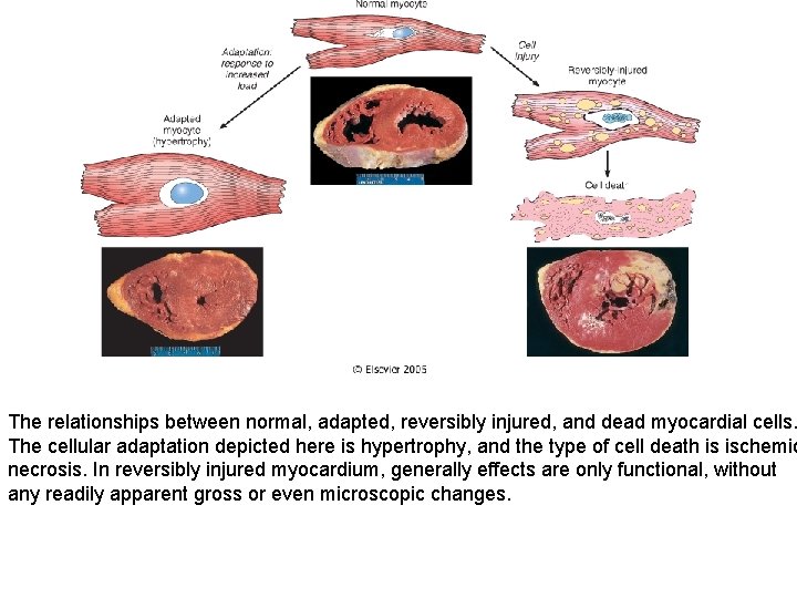 The relationships between normal, adapted, reversibly injured, and dead myocardial cells. The cellular adaptation